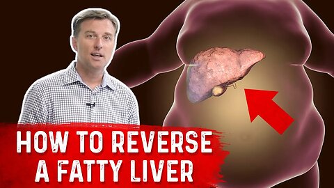 How to Reverse a Fatty Liver? - Dr. Berg