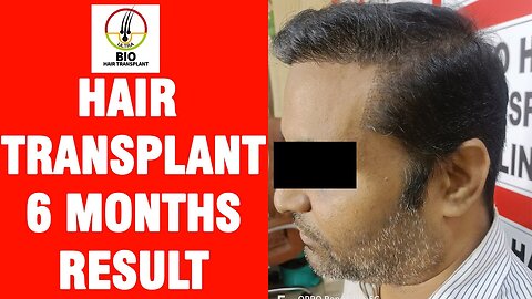 Hair Transplant 6 Months Results