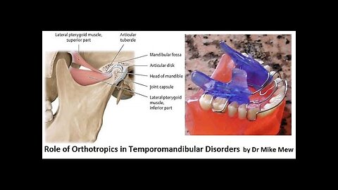 Orthotropics Treatment of Temporomandibular Joint Disorders by Dr Mike Mew