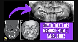 How to Create OPG Mandible From CT Facial Bones.? ( Cannon 320 Slice Scanner)