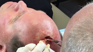 Removal of galeal lipoma on scalp