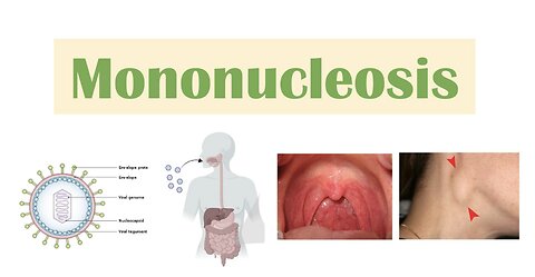 Infectious Mononucleosis (Mono) | Epstein-Barr Virus, Transmission, Symptoms, Diagnosis, Treatment