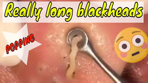 Really long blackheads popping out 😳🪱 #blackheadremoval #blackhead #blackheads #blackheadsremoval