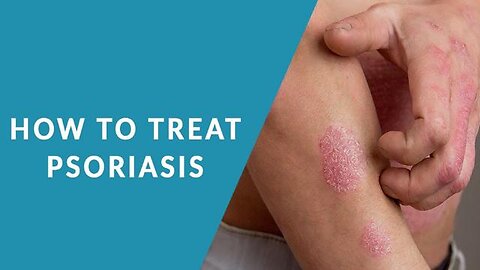 HOW TO TREAT PSORIASIS FAST AT HOME?