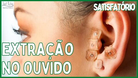 Remoção de Cravos na Orelha #03 - Removal of Blackheads in the Ear - Vídeo Satisfatório - Just Relax