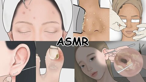 Pimple popping, Ear Wax, Ingrown toenail | Super Satisfying ASMR Compilation!