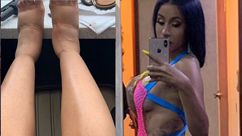 Cardi B CLAPS BACK With A NASTY Photo Of Her Swollen Feet!