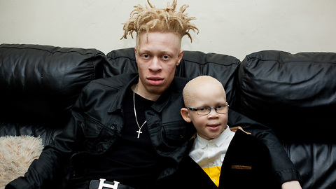 Article Headline: Model With Albinism Inspires Kids With Condition | BORN DIFFERENT