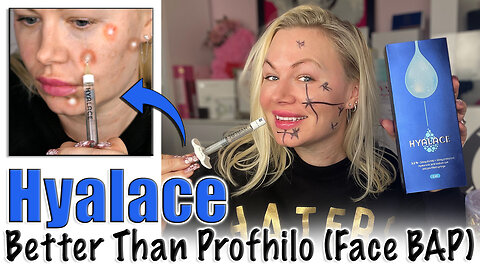 Hyalace (Better then Profhilo) Face BAP to Deeply Hydrate the Skin, Acecosm | Code Jessica10