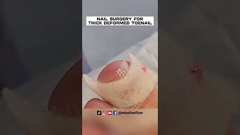 NAIL SURGERY FOR THICK DEFORMED TOENAIL 2023 BY FOOT DOCTOR MISS FOOT FIXER