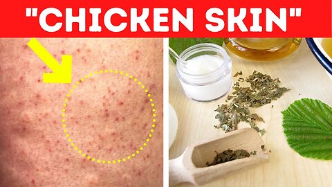Here's How To Get Rid Of Chicken Skin Fast (Keratosis Pilaris)