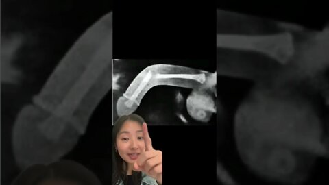 Can you Really Break This Bone?