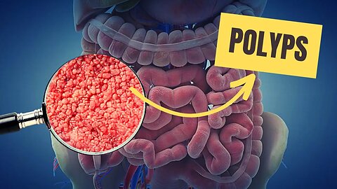Defeat Polyps Naturally! Home Remedies for a Happy, Healthy Colon!
