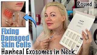 Fixing Damaged Skin Cells with Hanheal Exosomes in Neck, Round 1 AceCosm | Code Jessica10 Saves $$$