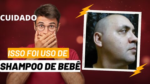 ISSO FOI USO DE SHAMPOO DE BEBÊ? VEJA ! #barba #minoxidil #cuidadoscomabarba #SHAMPOODEBARBA