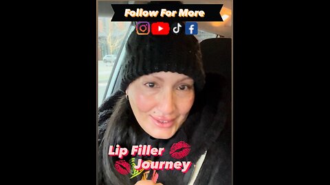 Lip Filler Journey with Fresh Faces Rx