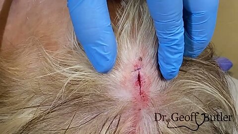 Dr. Jane removes her first Pilar Cyst!