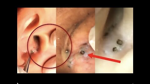 BLACKHEAD REMOVAL (VIDEO COMPILATION) *SATISFYING!*