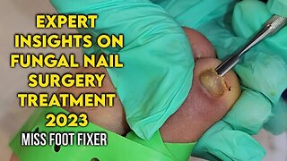 Expert Insights on Fungal Nail Surgery: Restoring Healthy Nail by famous foot doctor miss foot fixer