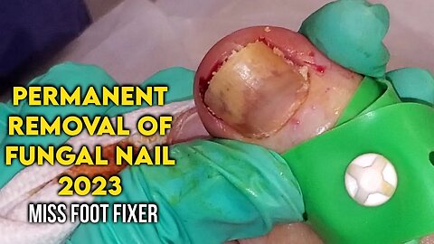 Permanent Removal Of Fungal Nail 2023 - Nail fungus uk By Famous Foot Doctor Miss Foot Fixer