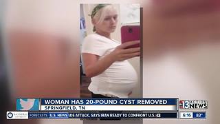Woman has 20-pound cyst removed