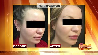 A "Closed Face Lift" with Natural Results
