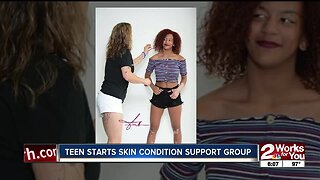 Teen starts skin condition support group