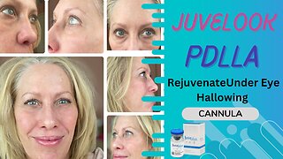 Juvelook PDLLA for Under Eye Hollowing Before & After Results