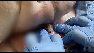 Drainage of an Ischiorectal Abscess (READ CAPTION)