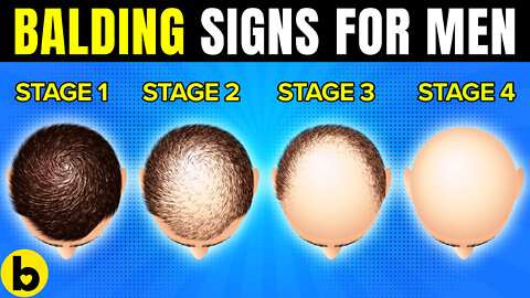 7 Warning Signs Of Balding In Men
