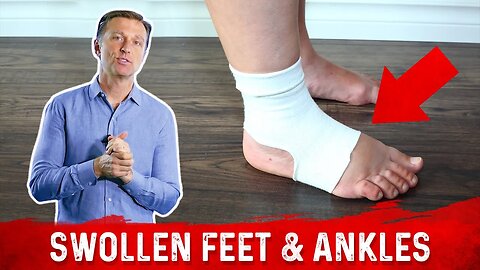 Foods for Fluid Retention in the Feet and Ankles – Dr.Berg