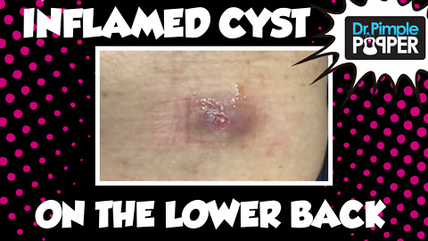 Inflamed cyst I & D wick on the lower back