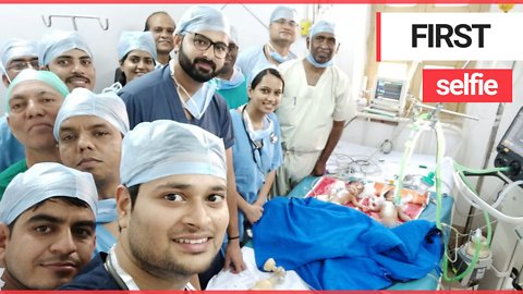 Surgeons separated 3-day-old conjoined twins in painstaking operation