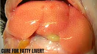 CURE FOR FATTY LIVER!!!!