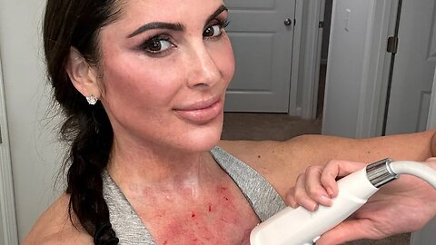 DIY| How to get MORPHEUS 8 results with RF MICRONEEDLING at Home Device Improve Skin Tightening Lift