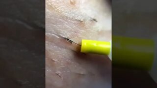 Compilation extração de pelos - Remove Squeezing Blackheads and Pimples - Just Relax | Apenas Relaxe