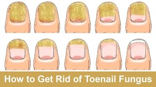 How to Get Rid of Toenail Fungus Fast and Naturally