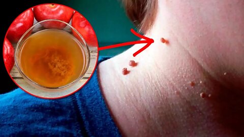 How to Remove Skin Tags Naturally at Home