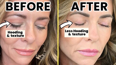 DIY HOODED EYES Fix | TCA Peel Treatment at Home Guide