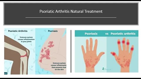 Psoriatic Arthritis Natural Treatment