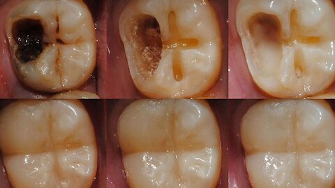 Teeth Cavity Treatment!