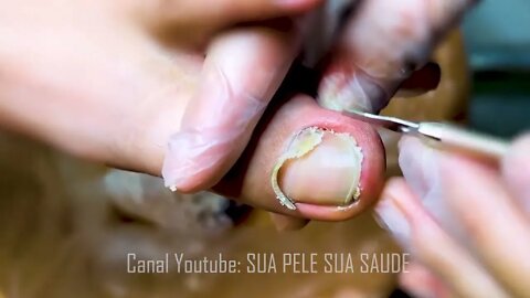 Manicure Unclogging the toenail Solve your problem #10 | 2022 Video