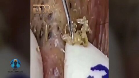 Removal/extraction of large blackheads on the face.