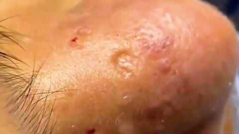 Satisfactory Video Blackhead Removal Skin Cleansing #19 | 2022 Video
