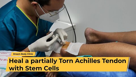 Heal a Partially Torn Achilles Tendon with Stem Cells