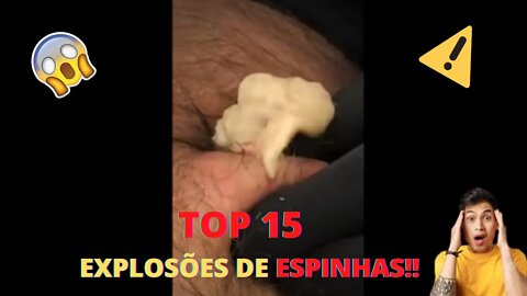 Top 15 vídeos de espinhas gigantes inflamadas! EXPLOSÕES DE ESPINHAS! Vídeos de Espinhas e cravos!