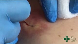 Removal of an Epidermal Cyst