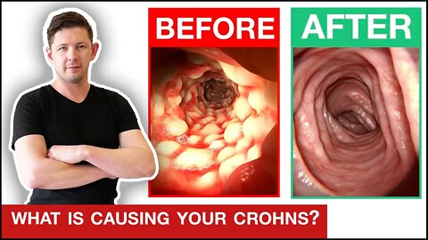 How To Heal Crohn's Disease - The FASTEST WAY POSSIBLE