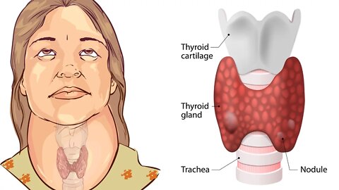 7 Warning Signs You May Have a Thyroid Problem