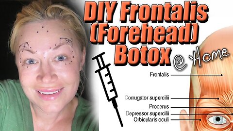 How I DIY Frontalis (Forehead) Botox at home | Code Jessica10 saves you Money